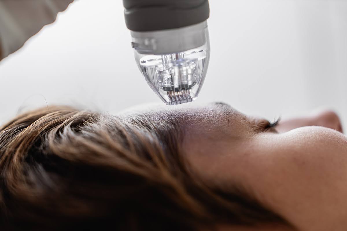 Microneedling in Seattle 1