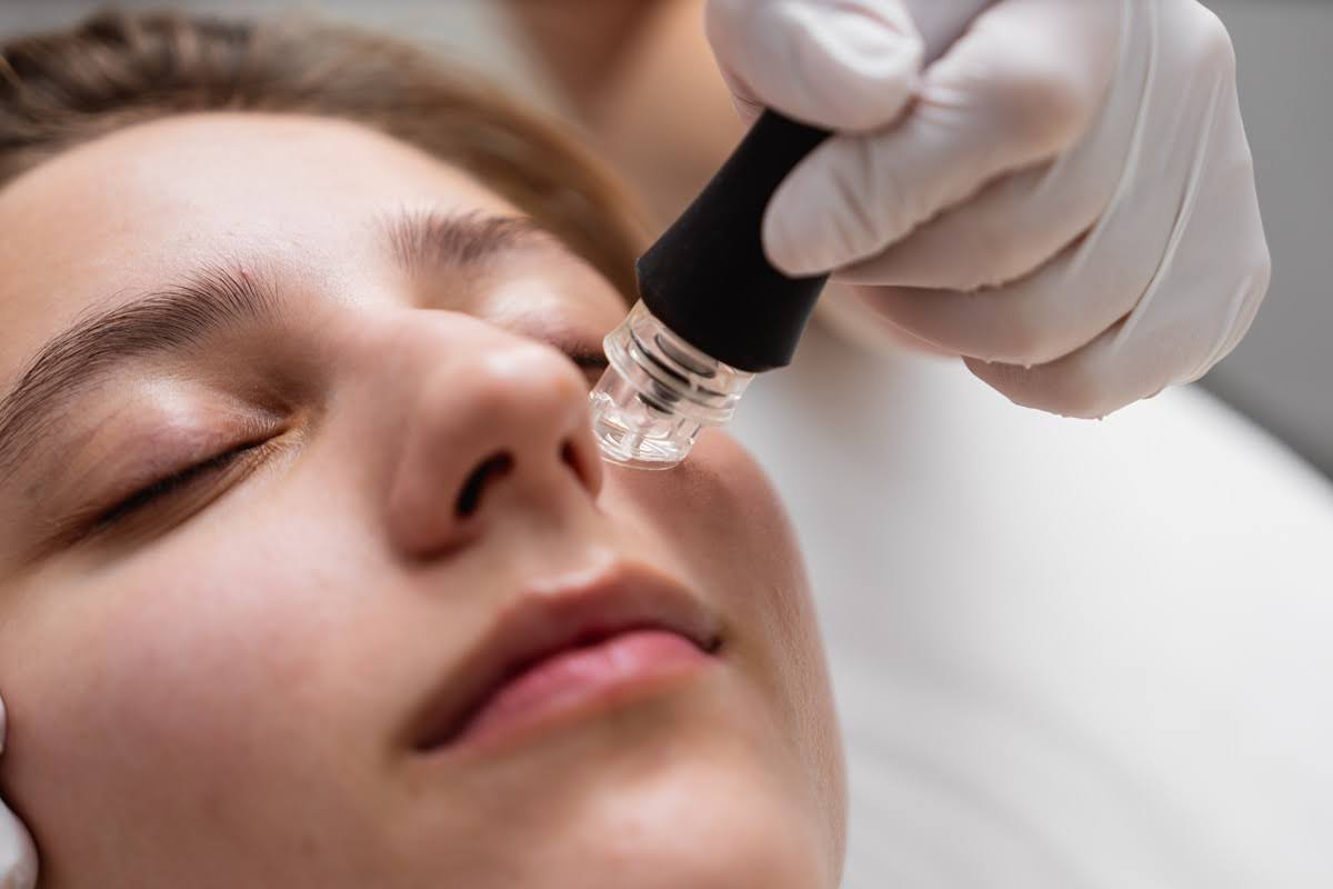 Microneedling in Seattle 5